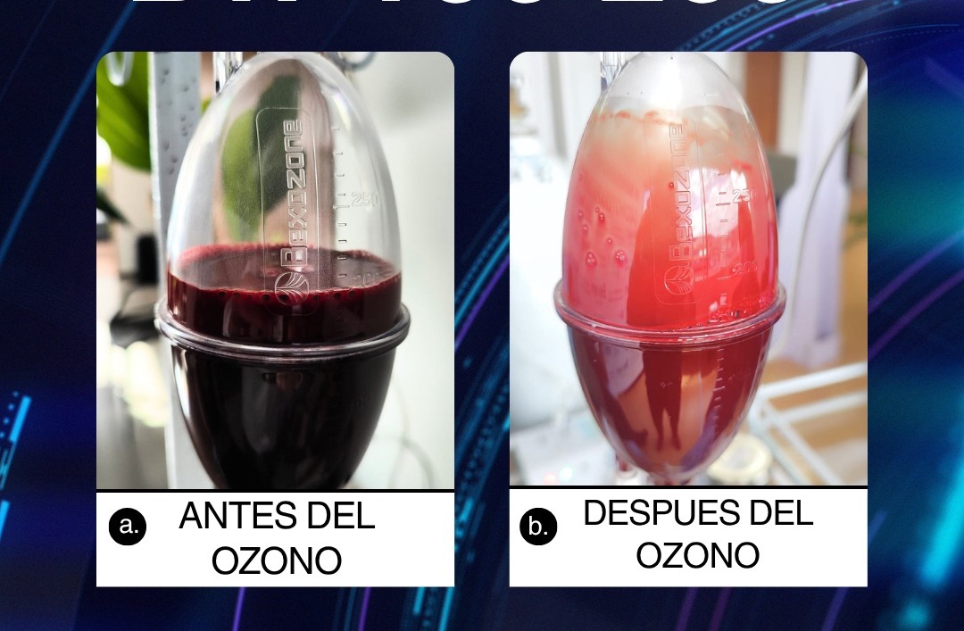 Comparativa de sangre antes del ozono y después del ozono con Bexozone