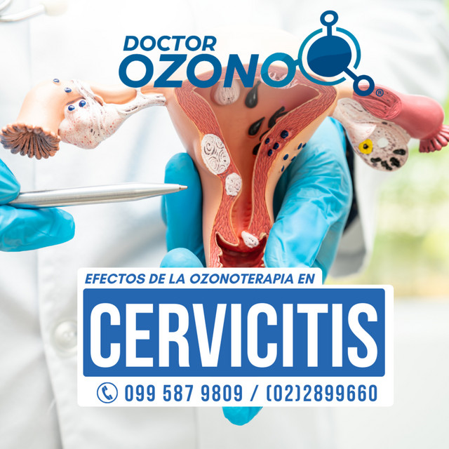 Portada de Efectos de la Ozonoterapia Intraperitoneal en Cervicitis