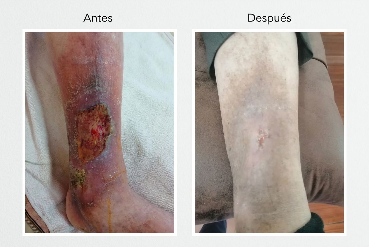 Úlcera varicosa en la pierna antes y después del tratamiento con ozonoterapia